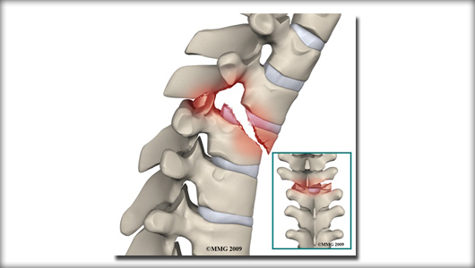 spine-fractures-intro
